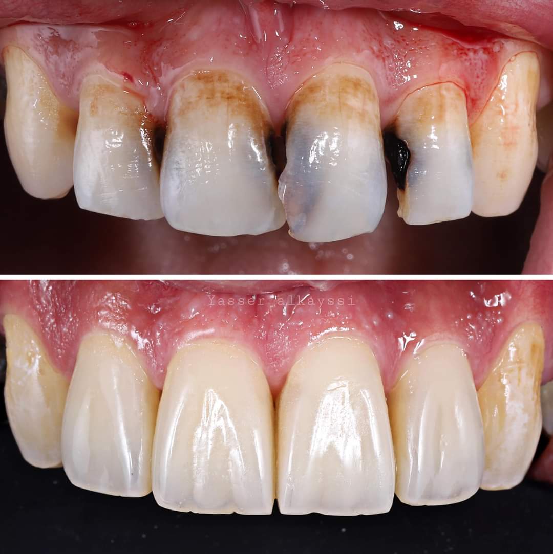 Arreglos y restauraciones dentales