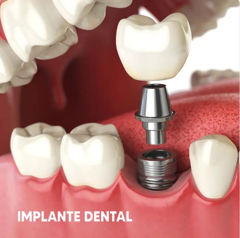 Implantes dentales